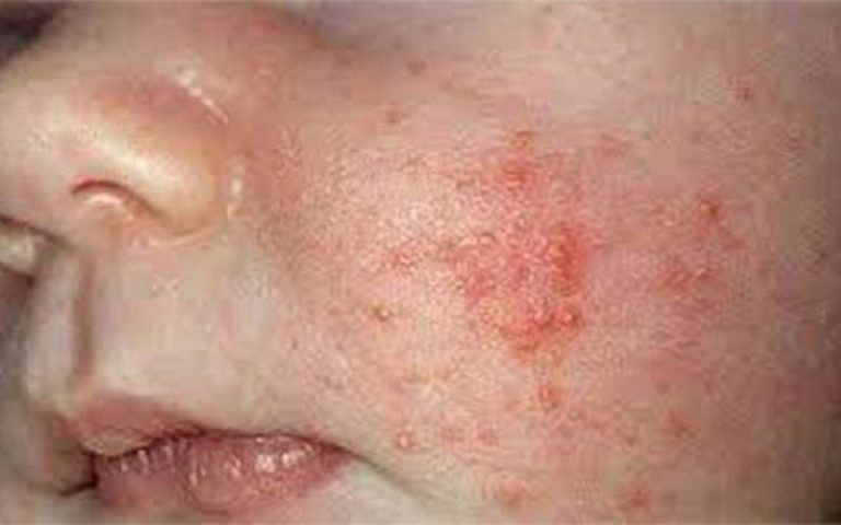 علائم "سرخک" و اهمیت واکسیناسیون کودکان در موعد مقرر