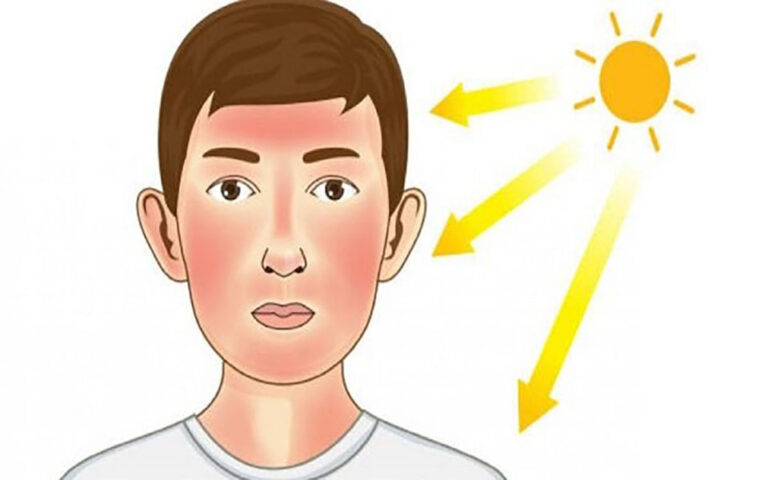 جلوگیری از آفتاب سوختگی با چند ماده غذایی