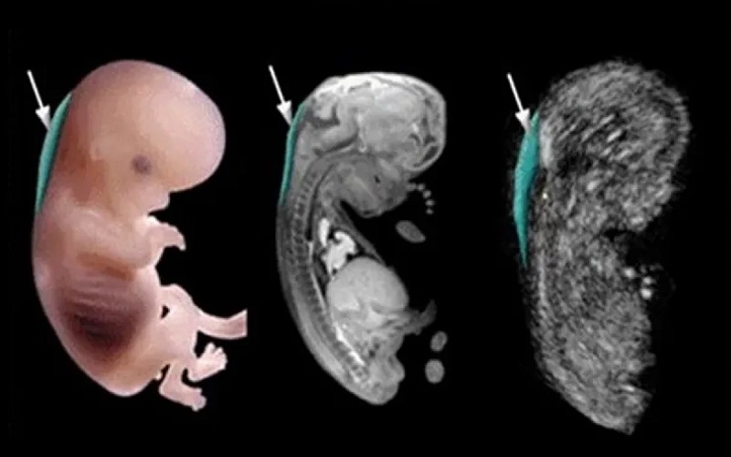 سونوگرافی NT