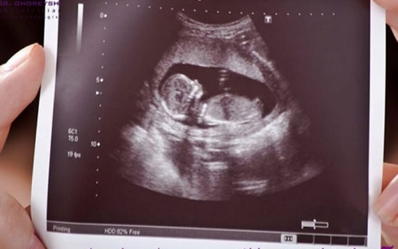 سونوگرافی آنومالی