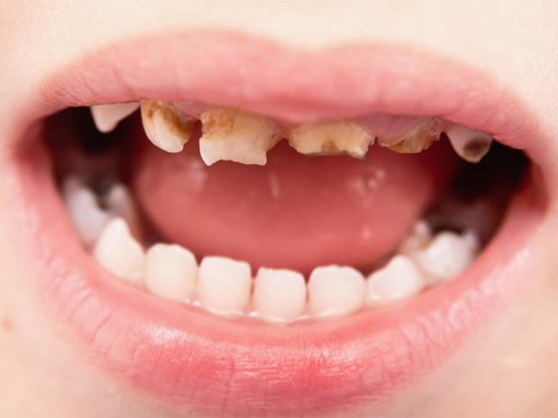پوسیدگی دندان 1