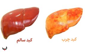 کبد چرب و کبد سالم