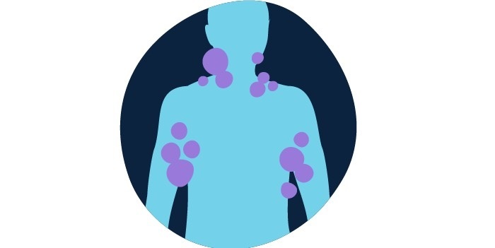 سرطان خون و همه چیز درباره نشانه های آن توده یا تورم
