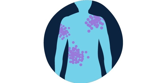 سرطان خون و همه چیز درباره نشانه های آن بثورات غیر قابل توضیح یا خارش پوست