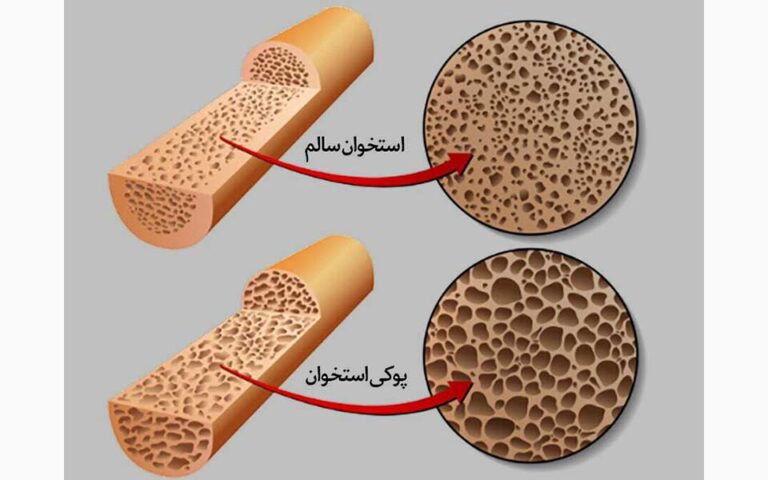 ضربه فنی پوکی استخوان با ویتامین D
