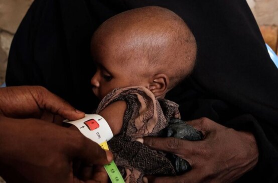 نوزاد مبتلا به سوء تغذیه در سومالی