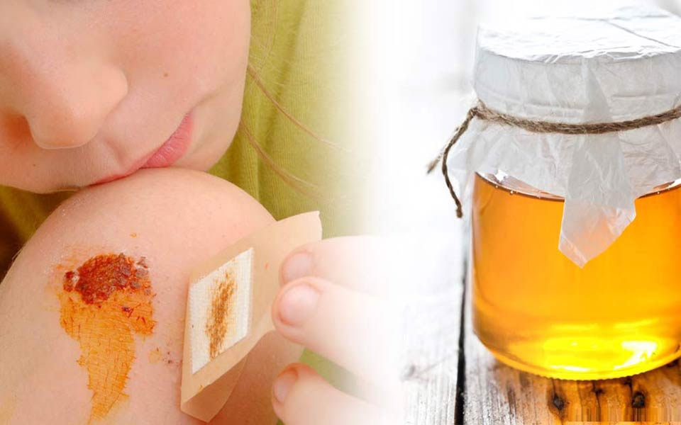 تاثیر عسل برای درمان سوختگی و التیام زخم‌