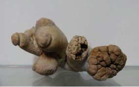 سنگ کلیه عجیبی که از بدن بیمار خارج شد
