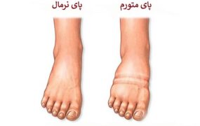 ورم پا و علل باور نکردنی آن