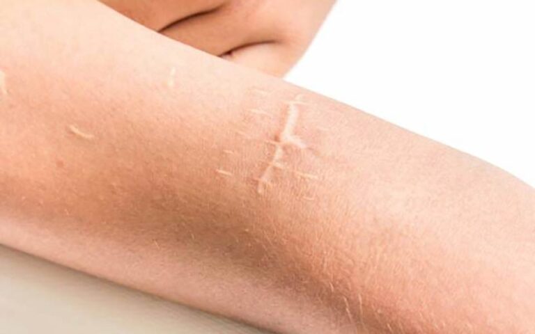 ۷ راهکار ساده برای از بین بردن جای زخم