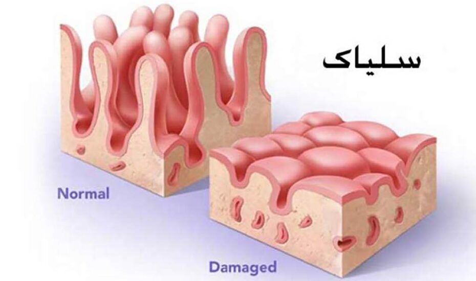 150بیمار سِلیاکی در کهگیلویه و بویراحمد شناسایی شدند