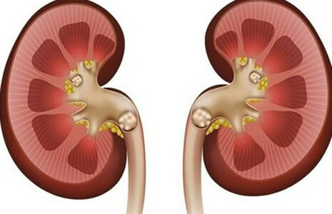 چه کنیم تا سنگ کلیه نگیریم؟