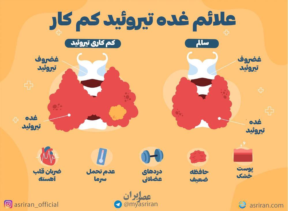 تیروئید کم کار