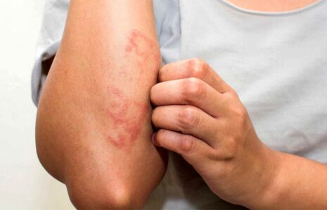 شایع‌ترین‌های بیماری‌های پوستی در نوروز