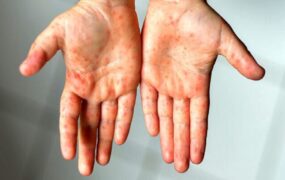 آماده باش ژاپن در پی شیوع مجدد سرخک