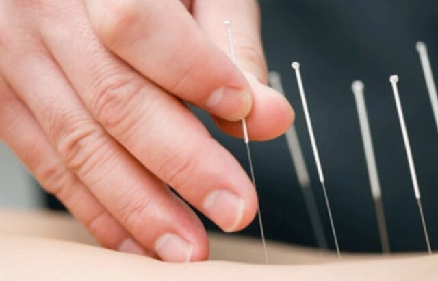 تاثیر طب سوزنی بر استرس