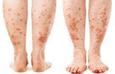 عوارض پوستی با دیابت