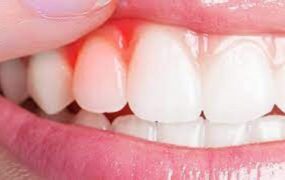 علائم عفونت لثه