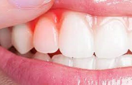 یکی از علائم شایع عفونت لثه علائم عفونت لثه
