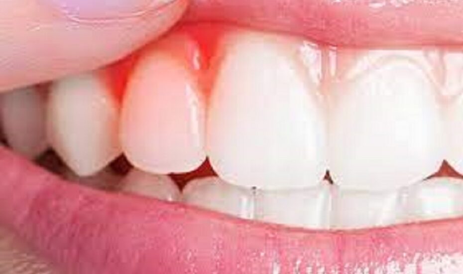 علائم عفونت لثه
