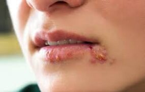 خوراکی انتقال ویروس تبخال