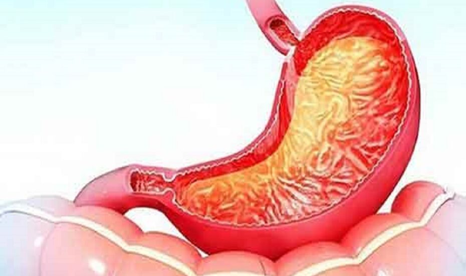 مواد غذایی‌ کاهش التهاب معده