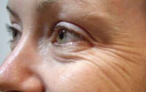 چروک‌ های عمیق صورت