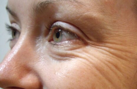 چروک‌ های عمیق صورت