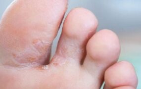 عفونت‌های قارچی پا