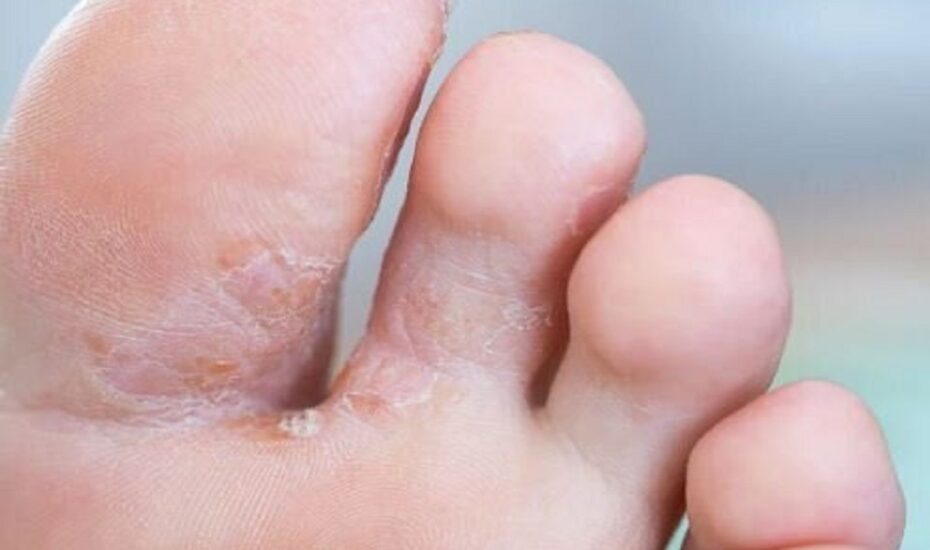 عفونت‌های قارچی پا