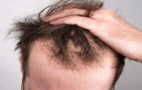 ۶ دلیل شایع ریزش موها