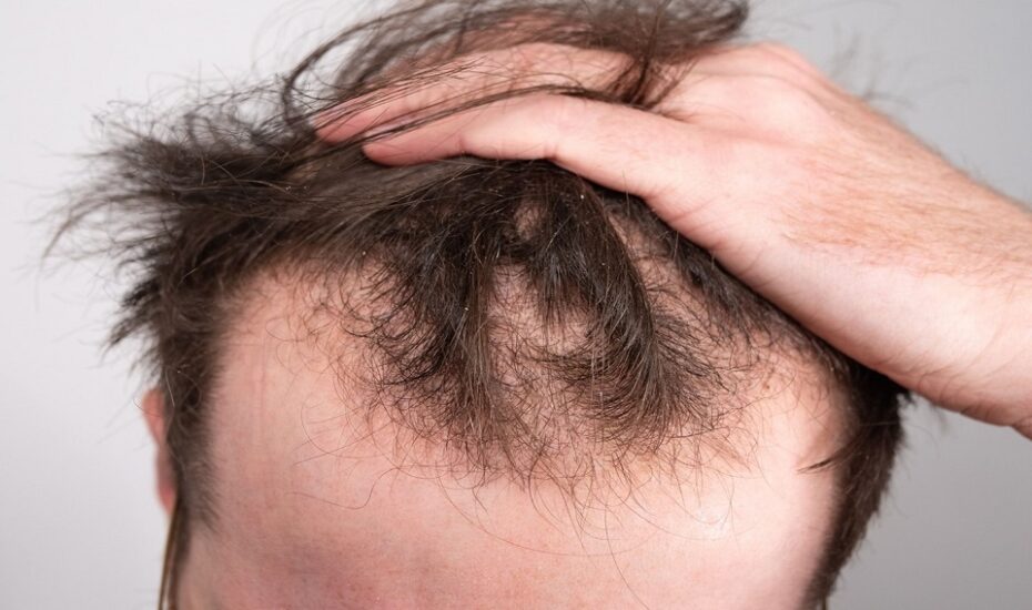 ۶ دلیل شایع ریزش موها