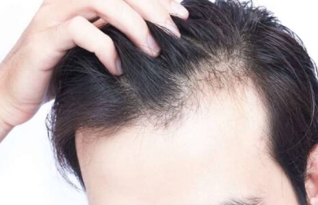 روش‌های مختلف جلوگیری از ریزش‌ مو
