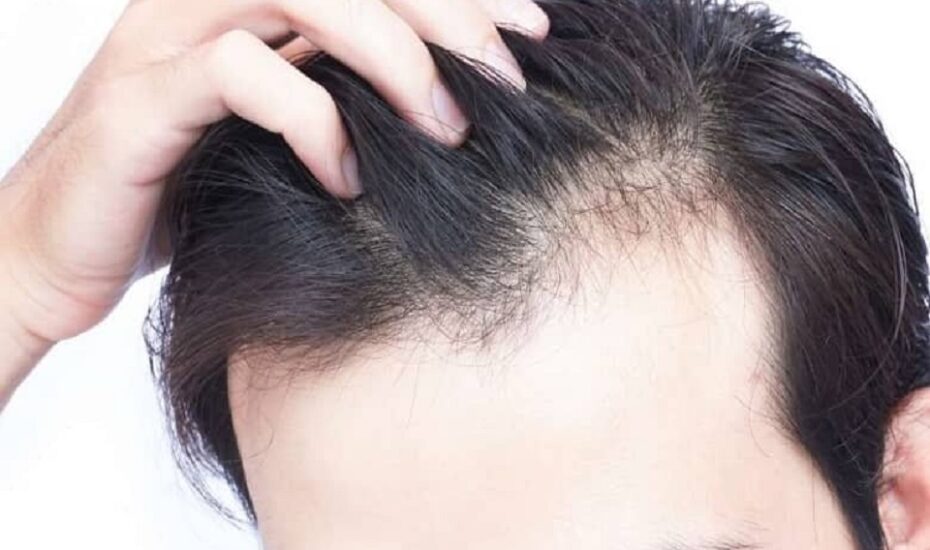 روش‌های مختلف جلوگیری از ریزش‌ مو