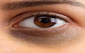 عوامل تیرگی دور چشم کدامند؟