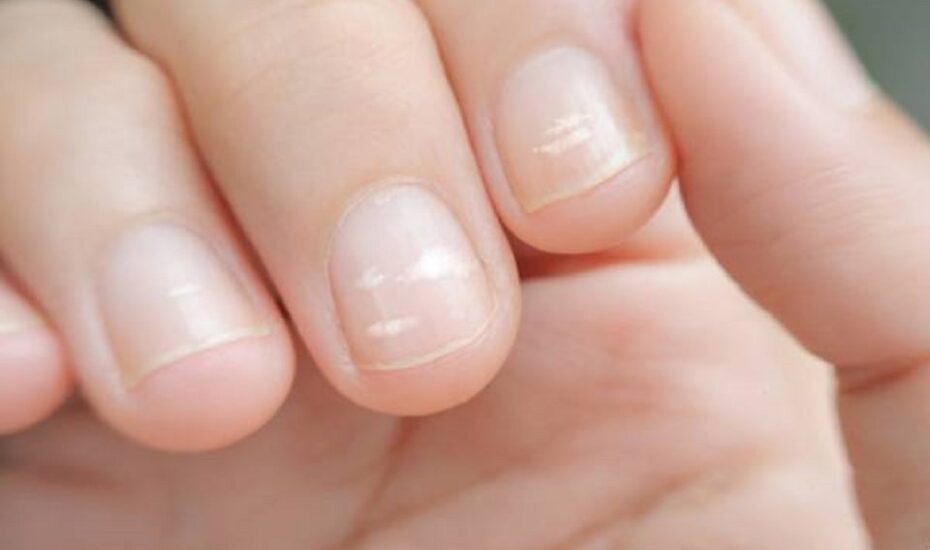علت به وجود آمدن لکه‌ی سفید روی ناخن