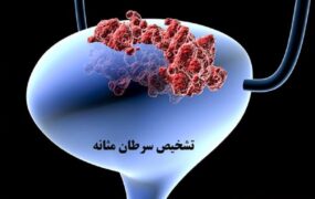 سرطان مثانه