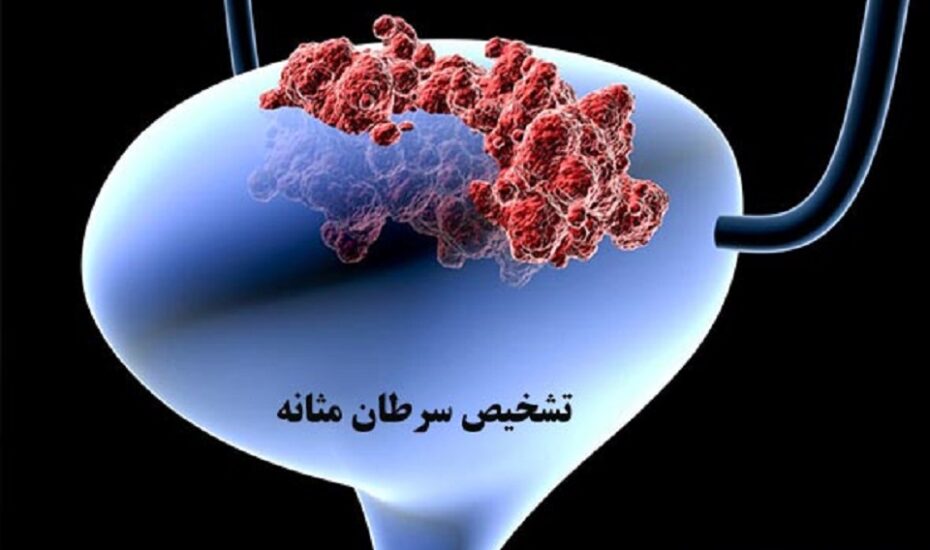 سرطان مثانه