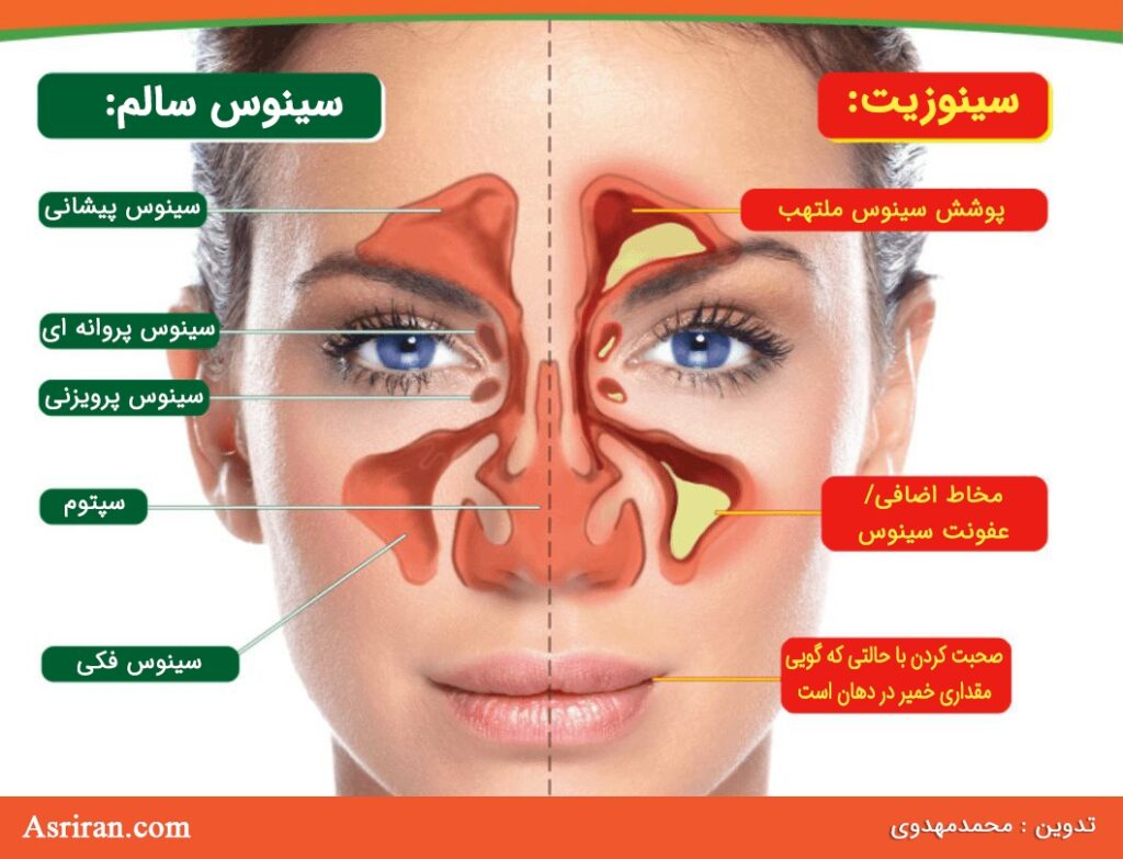 غلبه بر عفونت سینوس