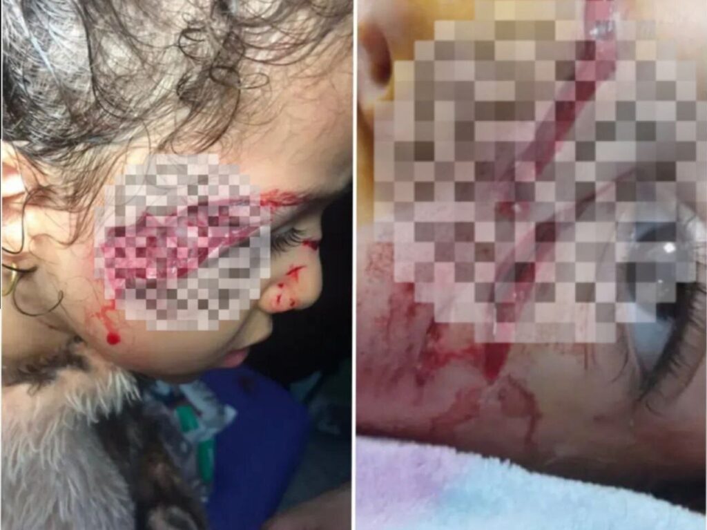 حمله سگ‌های ولگرد ‌به دختر ۵ ساله