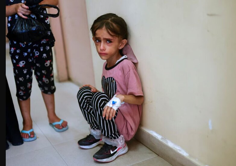 کودکان دچار سوء تغذیه در نوار غزه