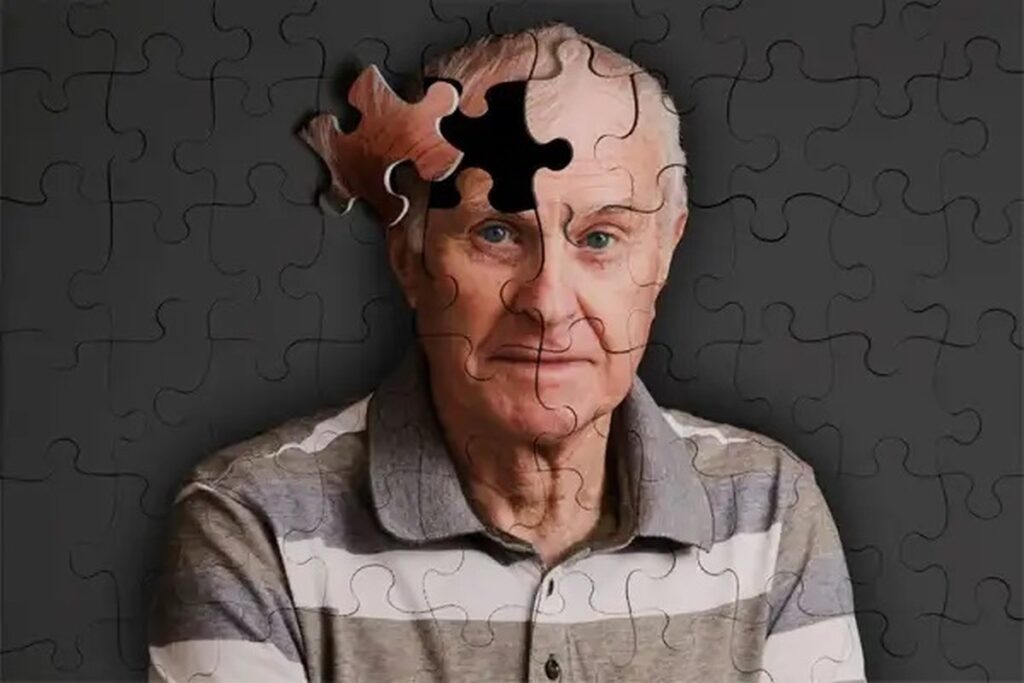 آلزایمر