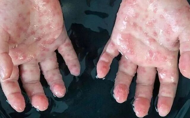 آبله میمون