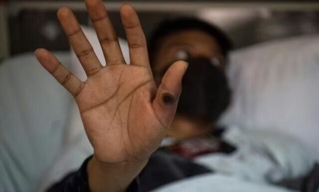 آبله میمون