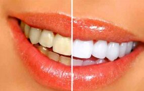 اشتباهی که باعث زردی دندان‌ها می‌شود