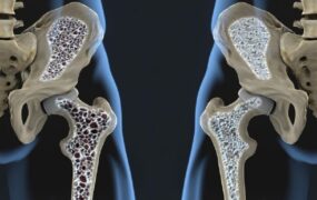 موثرترین راه پیشگیری از پوکی استخوان