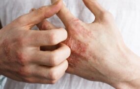 اگزما تنفس هوای آلوده