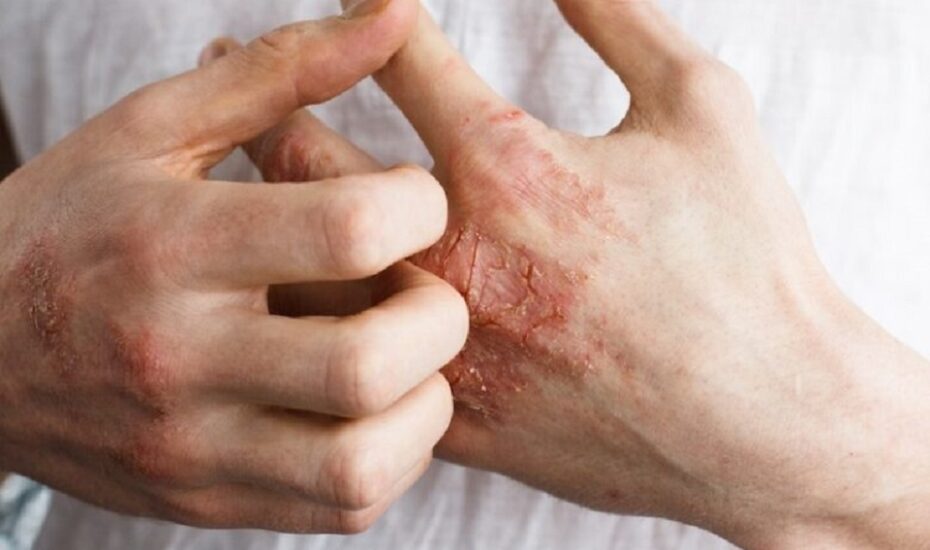 اگزما تنفس هوای آلوده