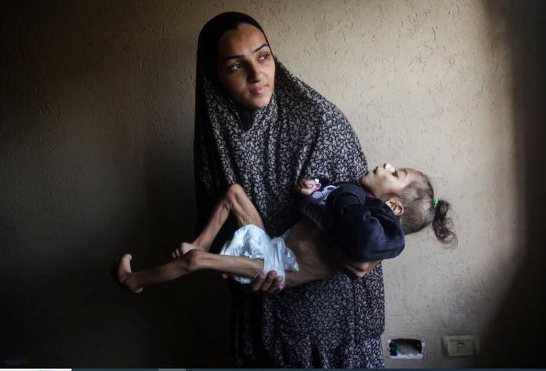 کودک 5 ساله فلسطینی دچار سوء تغذیه