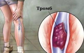 برای جلوگیری از لخته شدن خون چه باید کرد؟